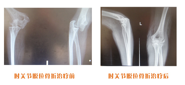 肘關(guān)節(jié)脫位骨折治療前后對(duì)比